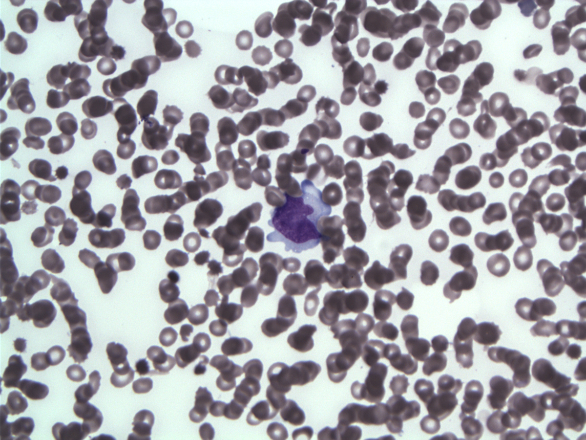 Lymphoma cell on WG-stained imprints